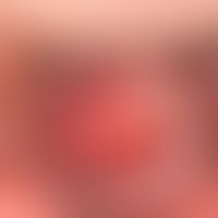 Balanitis plasmacellularis:&nbsp;seit mehreren Monaten bestehende, monozentrische, therapieresist...