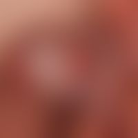 Balanoposthitis plasmacellularis:&nbsp;multizentrische, therapieresistente, wenig juckende, unsch...