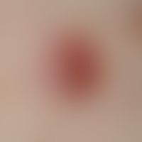 Basal cell carcinoma (overview): Nodular basal cell carcinoma with a shiny, smooth surface inters...