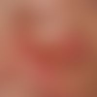 Basalzellkarzinom (Übersicht): Knotiges, im Zentrum zerfallendes Basalzellkarzinom, exzessive Aus...
