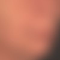 Basal cell carcinoma pigmented
