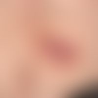 Basalzellkarzinom superfizielles. Ekzemartiger Aspekt. Nur im Randbereich läßt sich bei Vergrößer...