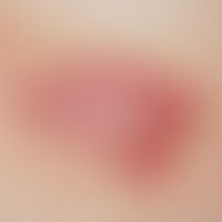 Basal cell carcinoma (overview): Basal cell carcinoma superficial, detailed view.
