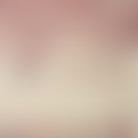 basal cell carcinoma, destructive. deeply infiltrating basal cell carcinoma at the capillitium. r...