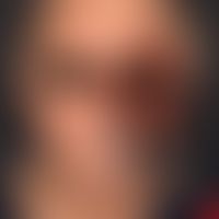 Basal cell carcinoma, destructive. overview: Since many years progressive, large-area, slightly p...