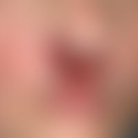 Basal cell carcinoma, destructive: ulcer measuring approx. 3 x 4 cm with glassy papules strung to...