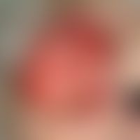 Basal cell carcinoma, destructive, since many years progressive, large-area, protuberant, foetid ...