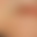 Basal cell carcinoma, nodular, painless conglomerate of 0.1-0.3 cm large, whitish nodules, which ...