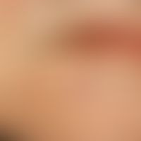 Basal cell carcinoma, nodular, painless conglomerate of 0.1-0.3 cm large, whitish nodules, which ...
