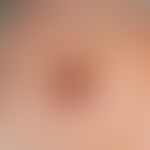 Basal cell carcinoma, nodular, centrally ulcerated tumor with a clear wall at the edge of the tem...