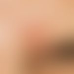 Basal cell carcinoma, nodular. aggregate of several, skin-coloured, firm, surface-smooth, shiny, ...
