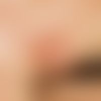 Basal cell carcinoma, nodular. aggregate of several, skin-coloured, firm, surface-smooth, shiny, ...