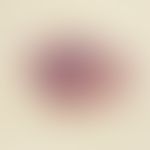 Basal cell carcinoma, nodular. Undifferentiated solid basal cell carcinoma. Strongly developed co...