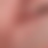 Basal cell carcinoma, nodular. 2.5 years of persistent, slowly growing, now 1.8 x 2.3 cm large, c...