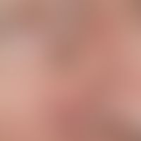 Basal cell carcinoma, nodular, 72-year-old female patient, solitary, chronically dynamic, continu...