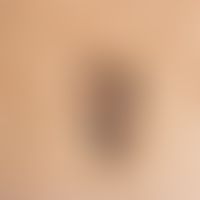 Basal cell carcinoma, pigmented, sharply defined, irregularly pigmented plaque with individual de...