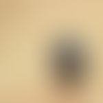 Basalzellkarzinom, pigmentiertes. Schwarz-braun gefärbter, schmerzloser Knoten mit zentraler Eros...
