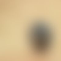 Basal cell carcinoma, pigmented, black-brown stained, painless nodule with central erosion as wel...