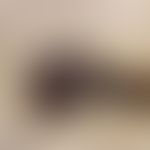Basalzellkarzinom, pigmentiertes. Teils knotiges, teils nur im Hautniveau wachsendes pigmentierte...
