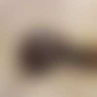 Basal cell carcinoma, pigmented basal cell carcinoma, partly nodular, partly growing only in the ...