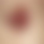 Basalzellkarzinom, pigmentiertes. 6 cm im Durchmesser große, randständig deutlich elevierte, im Z...