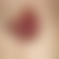Basal cell carcinoma, pigmented. 6 cm in diameter, clearly elevated at the edges, flattened in th...