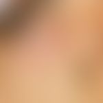 Basalzellkarzinom, sklerodermiformes: &nbsp;seit Jahren bestehende, langsam wachsende, scharf beg...