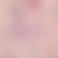 Basalzellkarzinom, sklerodermiformes. Unscharf begrenzter Tumor aus ungeordneten, schmalen, bizar...