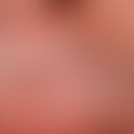 Basalzellkarzinom, sklerodermiformes. Schwierig zu diagnostizierender Befund bei einem 58-jährige...