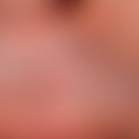 Basalzellkarzinom, sklerodermiformes. Schwierig zu diagnostizierender Befund bei einem 58-jährige...