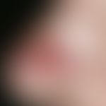 Basalzellkarzinom, sklerodermiformes. Bei der 82-jährigen Patientin besteht eine ca. 1 x 1 cm mes...