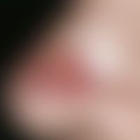 Basalzellkarzinom, sklerodermiformes. Bei der 82-jährigen Patientin besteht eine ca. 1 x 1 cm mes...