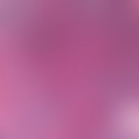 Basal cell carcinoma, solid. intensely basophilic, solid epithelial strands consisting of largely...