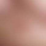 Basal cell carcinoma, solid, sharply defined, slow-growing, approx. 5 mm diameter, smooth, shiny,...