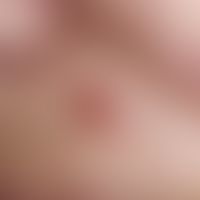 Basal cell carcinoma, solid, sharply defined, slow-growing, approx. 5 mm diameter, smooth, shiny,...