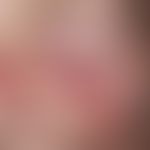 Basal cell carcinoma, solid. solitary, chronically dynamic, 1.2 x 0.8 cm in size, well defined, f...