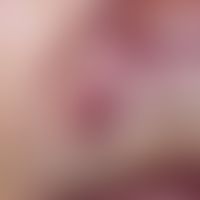 Basal cell carcinoma, solid. chronic, reddish lump with a shiny, smooth surface. clinical and inc...