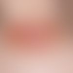 Basal cell carcinoma, superficial, sharply defined, brownish, centrally atrophic plaque with tela...