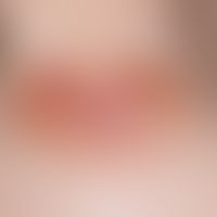 Basalzellkarzinom, superfizielles. Scharf begrenzte, bräunliche, zentral atrophische, von Teleang...