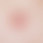 Basal cell carcinoma, superficial, sharply defined, centrally slightly atrophic, scaly plaque in ...