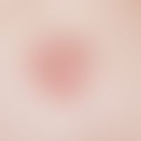 Basalzellkarzinom, superfizielles:&nbsp;scharf begrenzte, zentral leicht atrophische, schuppende,...