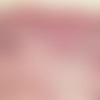 Basalzellkarzinom, superfizielles. Atrophische, orthokeratotische Epidermis; im Zentrum knospenar...