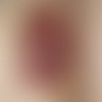 Basal cell carcinoma, superficial, supposedly only existing for 1/2 year, which was treated as my...