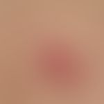 Basal cell carcinoma, superficial. for at least 4 years persistent, size constant, sharply define...
