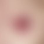 Basal cell carcinoma, superficial, slow-growing, sharply defined, coin-sized, reddish-brownish, l...