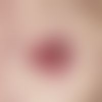 Basalzellkarzinom, superfizielles:&nbsp;langsam wachsende, scharf begrenzte, münzgroße, rötlich-b...