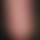 Beau-Reils transverse furrows of the nails. general view: For several years persistent transverse...