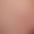Spider veins: Dark blue-red, 0.5-1.0 mm thick, tortuous dilated venules with irregular, ampulla o...