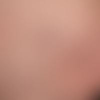 Spider veins: Dark blue-red, 0.5-1.0 mm thick, tortuous dilated venules with irregular, ampulla o...