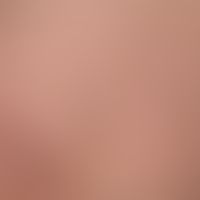 Spider veins. dark blue-red, 0.5-2.0 mm wide, tortuous varicose veins with irregular, ampulla- or...